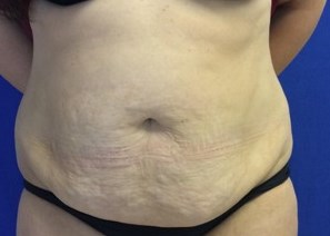 Pre op Tummy Tuck